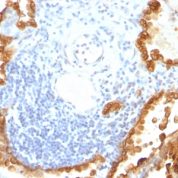 Formalin-fixed, paraffin-embedded human Ovarian Carcinoma stained with Cytokeratin 8/18 Monoclonal Antibody (KRT8/83 + KRT18/835).
