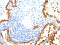 Formalin-fixed, paraffin-embedded human Ovarian Carcinoma stained with Cytokeratin 8/18 Monoclonal Antibody (KRT8/83 + KRT18/835).