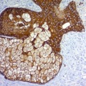 Formalin-fixed, paraffin-embedded human Skin stained with Cytokeratin, pan Monoclonal Antibody cocktail (PAN-CK).