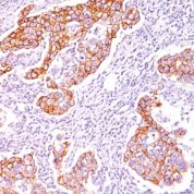 Formalin-fixed, paraffin-embedded human Breast Carcinoma stained with Phosphotyrosine Monoclonal Antibody (SPM12).