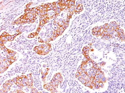 Formalin-fixed, paraffin-embedded human Breast Carcinoma stained with Phosphotyrosine Monoclonal Antibody (SPM12).