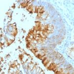 Formalin-fixed, paraffin-embedded human Colon Carcinoma stained with Lewis A Monoclonal Antibody (SPM279).