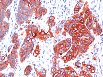Formalin-fixed, paraffin-embedded human Colon Carcinoma stained with Multi Cytokeratin Monoclonal Antibody (SPM583).