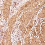 Formalin-fixed, paraffin-embedded human Leiomyosarcoma stained with Muscle Specific Actin Monoclonal Antibody (SPM16)