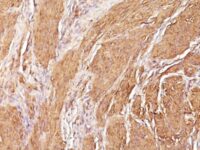 Formalin-fixed, paraffin-embedded human Leiomyosarcoma stained with Muscle Specific Actin Monoclonal Antibody (SPM16)