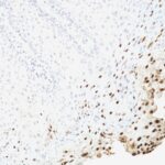 Formalin-fixed, paraffin-embedded human Cervix stained with HPV-16 Monoclonal Antibody (SPM257)