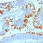 Formalin-fixed, paraffin-embedded human Colon Carcinoma stained with Lewis A Monoclonal Antibody (SPM522).