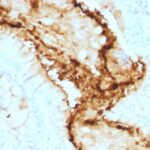 Formalin-fixed, paraffin-embedded human Colon Carcinoma stained with Lewis Y Monoclonal Antibody (A7-A/A9).