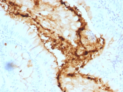 Formalin-fixed, paraffin-embedded human Colon Carcinoma stained with Lewis Y Monoclonal Antibody (A7-A/A9).