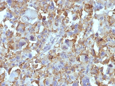 Formalin-fixed, paraffin-embedded human Histiocytoma stained with Macrophage Monoclonal Antibody (D11).
