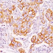 Formalin-fixed, paraffin-embedded human Breast Carcinoma stained with Phosphotyrosine Monoclonal Antibody (PY793).