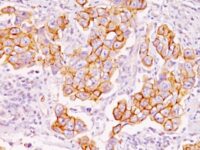 Formalin-fixed, paraffin-embedded human Breast Carcinoma stained with Phosphotyrosine Monoclonal Antibody (PY793).