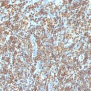 Formalin-fixed, paraffin-embedded human Colon Carcinoma stained with Double Stranded DNA Monoclonal Antibody (AE-2)