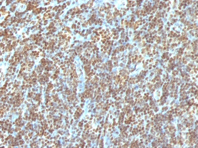 Formalin-fixed, paraffin-embedded human Colon Carcinoma stained with Double Stranded DNA Monoclonal Antibody (AE-2)