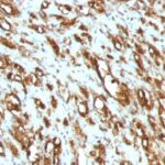 Formalin-fixed, paraffin-embedded human Leiomyosarcoma stained with Muscle Specific Actin Monoclonal Antibody (MSA/953)