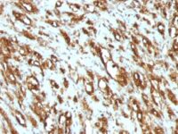 Formalin-fixed, paraffin-embedded human Leiomyosarcoma stained with Muscle Specific Actin Monoclonal Antibody (MSA/953)