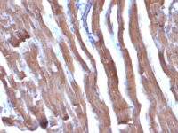 Formalin-fixed, paraffin-embedded human Leiomyosarcoma stained with Muscle Specific Actin Monoclonal Antibody (HHF35 + MSA/953)