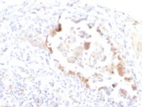 Formalin-fixed, paraffin-embedded human Lung Carcinoma stained with Lewis Y Monoclonal Antibody (LWY/1463).