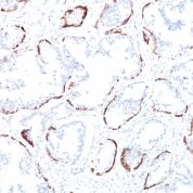 Formalin-fixed, paraffin-embedded human Prostate Carcinoma stained with Cytokeratin, HMW Monoclonal Antibody (34BE12).