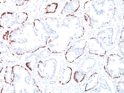 Formalin-fixed, paraffin-embedded human Prostate Carcinoma stained with Cytokeratin, HMW Monoclonal Antibody (34BE12).