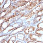 Formalin-fixed, paraffin-embedded human Bladder Carcinoma stained with Mitochondria Monoclonal Antibody (MTC719)