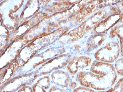 Formalin-fixed, paraffin-embedded human Bladder Carcinoma stained with Mitochondria Monoclonal Antibody (MTC719)