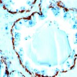 Formalin-fixed, paraffin-embedded human Prostate Carcinoma stained with Cytokeratin, HMW Monoclonal Antibody (SPM591).