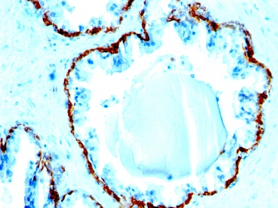 Formalin-fixed, paraffin-embedded human Prostate Carcinoma stained with Cytokeratin, HMW Monoclonal Antibody (SPM591).