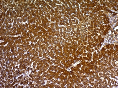 Formalin-fixed, paraffin-embedded human Hepatocellular Carcinoma stained with HepPar-1 Monoclonal Antibody (HepPar1).