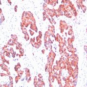 Formalin-fixed, paraffin-embedded human Breast Carcinoma stained with Cytokeratin, HMW Monoclonal Antibody (SPM116).