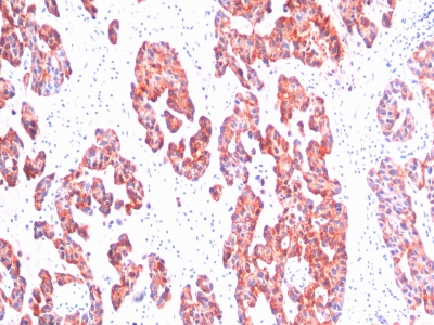 Formalin-fixed, paraffin-embedded human Breast Carcinoma stained with Cytokeratin, HMW Monoclonal Antibody (SPM116).