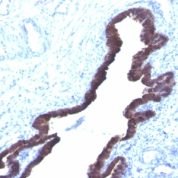 Formalin-fixed, paraffin-embedded human Colon Carcinoma stained with Cytokeratin 8/18 Monoclonal Antibody (K8.8 + DC1).