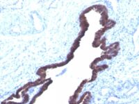 Formalin-fixed, paraffin-embedded human Colon Carcinoma stained with Cytokeratin 8/18 Monoclonal Antibody (K8.8 + DC1).