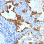 Formalin-fixed, paraffin-embedded human Lung Carcinoma stained with Cytokeratin 8/18 Monoclonal Antibody (SPM141).