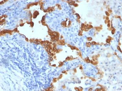 Formalin-fixed, paraffin-embedded human Lung Carcinoma stained with Cytokeratin 8/18 Monoclonal Antibody (SPM141).