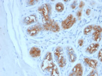 200 ul of predilute SingleStep™ Poly-HRP conjugated goat anti-mouse secondary antibody was incubated 30 minutes following anti-MUC-1 staining of human breast carcinoma.  Excellent signal intensity is observed in the absence of any additional amplification step.