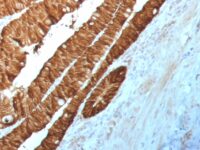 100 ul of predilute SingleStep™ Poly-HRP conjugated goat anti-rabbit secondary antibody was incubated 30 minutes following anti-EpCAM staining of human rectum samples.  Excellent signal intensity is observed in the absence of any additional amplification step.