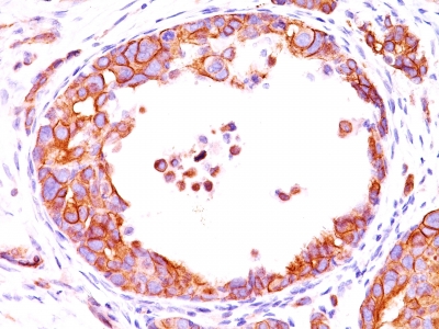 Formalin-fixed, paraffin-embedded human Breast Carcinoma stained with HER2 Monoclonal Antibody (HRB2/451).