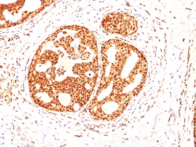 Formalin-fixed, paraffin-embedded human Breast Carcinoma stained with ER-beta1 Monoclonal Antibody (ESR2/686).