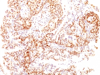 Formalin-fixed, paraffin-embedded human Ovarian Carcinoma stained with ER-beta1 Monoclonal Antibody (ESR2/686).