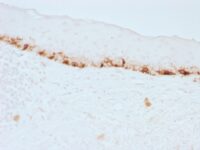 Formalin-fixed, paraffin-embedded human Skin stained with MART-1 Monoclonal Antibody (M2-7C1).