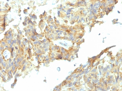 Formalin-fixed, paraffin-embedded human Ovarian Carcinoma stained with Alkaline Phosphatase Mouse Monoclonal Antibody (ALPL/597).