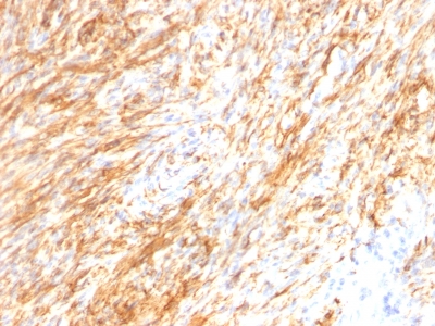 Formalin-fixed, paraffin-embedded human Schwanoma stained with GFAP Monoclonal Antibody (GA-5 + ASTRO/789).
