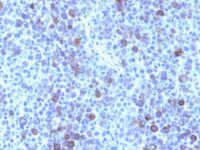 Formalin-fixed, paraffin-embedded human Melanoma stained with Glypican-3 Monoclonal Antibody (GPC3/863)