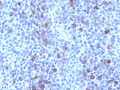 Formalin-fixed, paraffin-embedded human Melanoma stained with Glypican-3 Monoclonal Antibody (GPC3/863)
