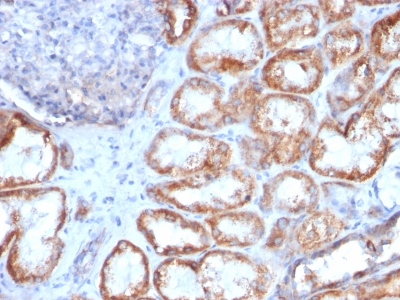 Formalin-fixed, paraffin-embedded human Renal Cell Carcinoma stained with HSP6 Monoclonal Antibody (HSPD1/78)
