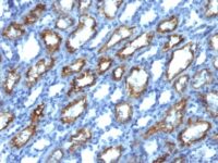 Formalin-fixed, paraffin-embedded human Renal Cell Carcinoma stained with Interferon gamma Monoclonal Antibody (IFNG/466)