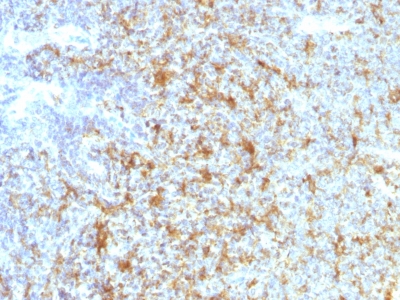 Formalin-fixed, paraffin-embedded human Follicular Lymphoma stained with CD11c Monoclonal Antibody (ITGAX/1243) at 1ug/ml. Antigen retrieval in 1mM Tris with 1mM EDTA, pH 9.; ABC detection system with DAB Chromogen. Note staining of cancer cells.
