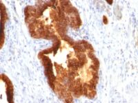 Formalin-fixed, paraffin-embedded human Prostate Carcinoma stained with Cytokeratin 18 Monoclonal Antibody (KRT18/835).