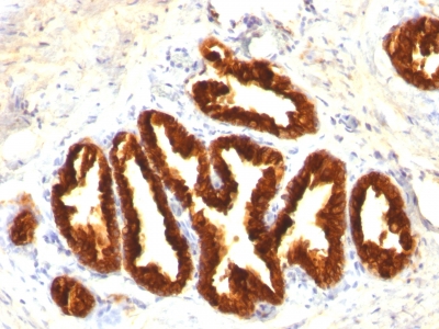Formalin-fixed, paraffin-embedded human Prostate Carcinoma stained with Cytokeratin 18 Monoclonal Antibody (Cocktail).